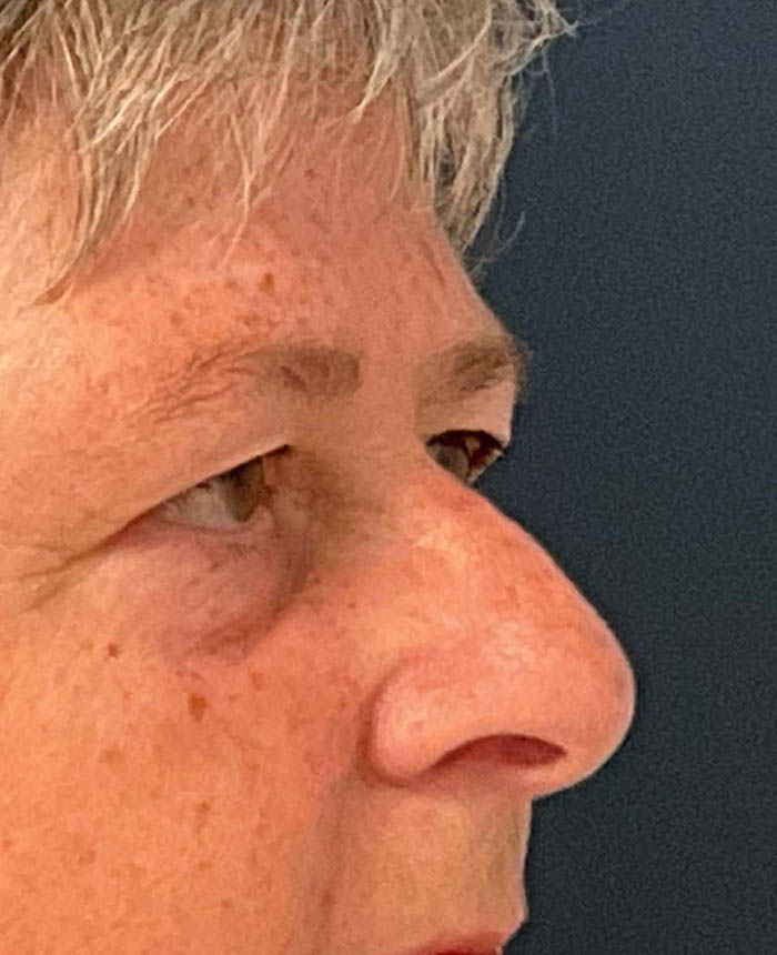 Eyelid Surgery case #9708
