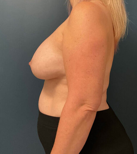 Breast Implant Exchange case #9719