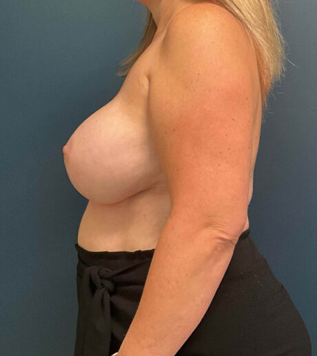 Breast Implant Exchange case #9719