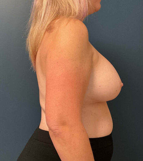 Breast Implant Exchange case #9719