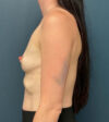 Breast Augmentation case #9821