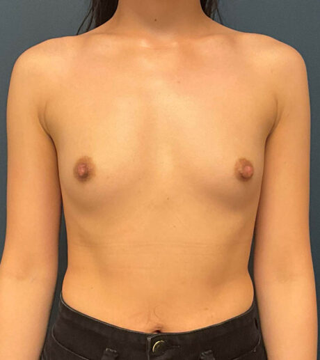 Breast Augmentation case #9834
