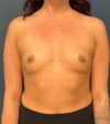 Breast Augmentation case #9856