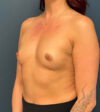 Breast Augmentation case #9856