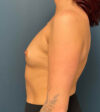 Breast Augmentation case #9856