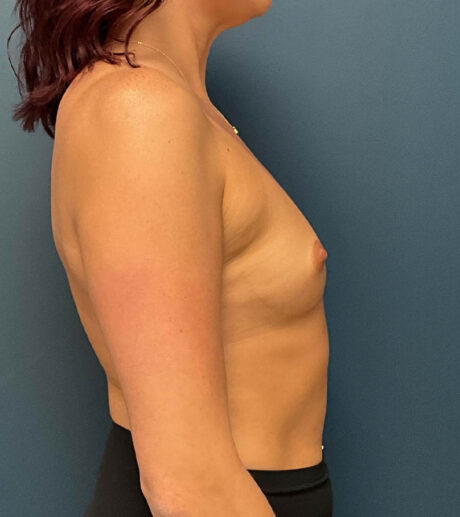 Breast Augmentation case #9856