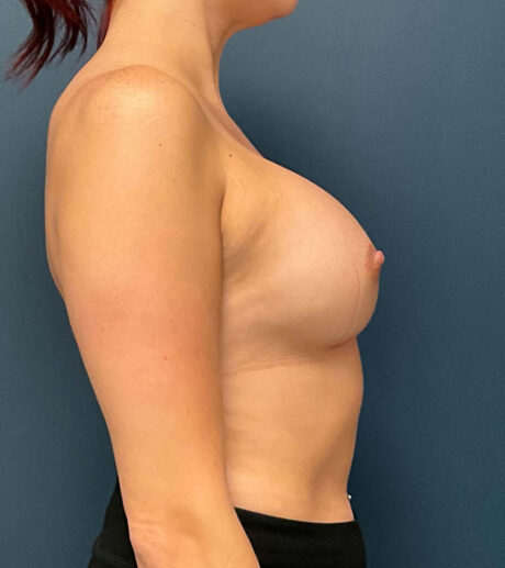 Breast Augmentation case #9856