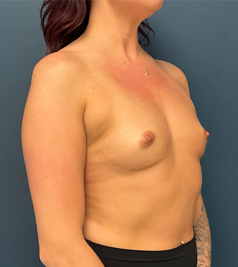 Breast Augmentation case #9856