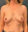 Breast Augmentation case #9880