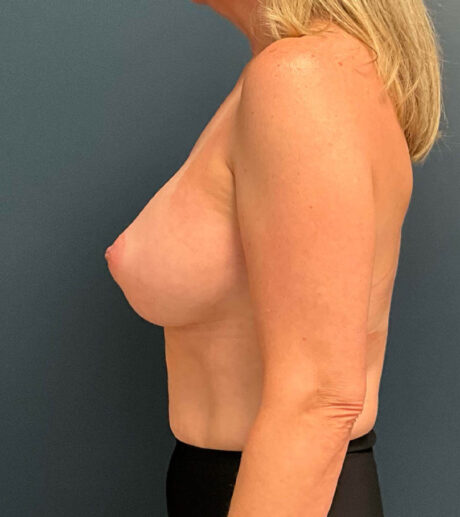 Breast Augmentation case #9880