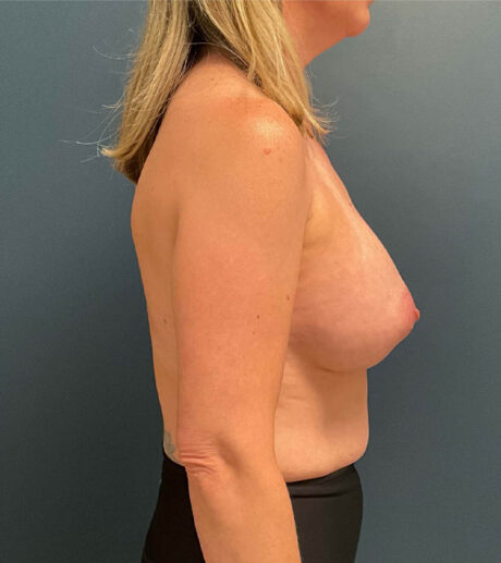 Breast Augmentation case #9880