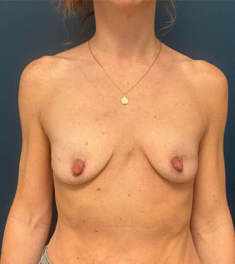 Breast Augmentation case #9891