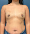 Breast Augmentation case #9903