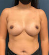 Breast Augmentation case #9903