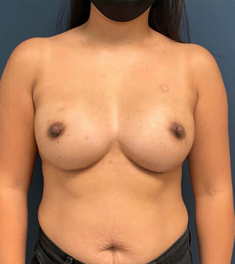Breast Augmentation case #9903
