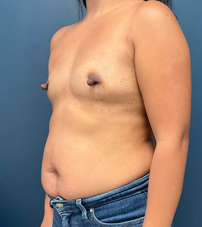 Breast Augmentation case #9903