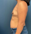 Breast Augmentation case #9903