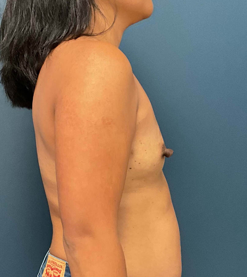 Breast Augmentation case #9903