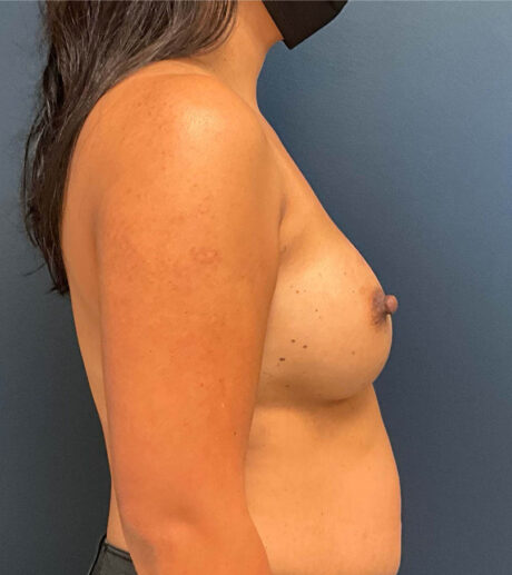 Breast Augmentation case #9903