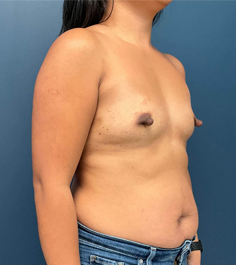 Breast Augmentation case #9903