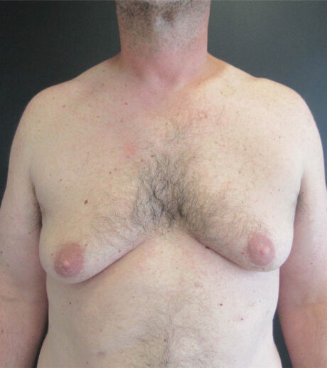 Gynecomastia case #9914