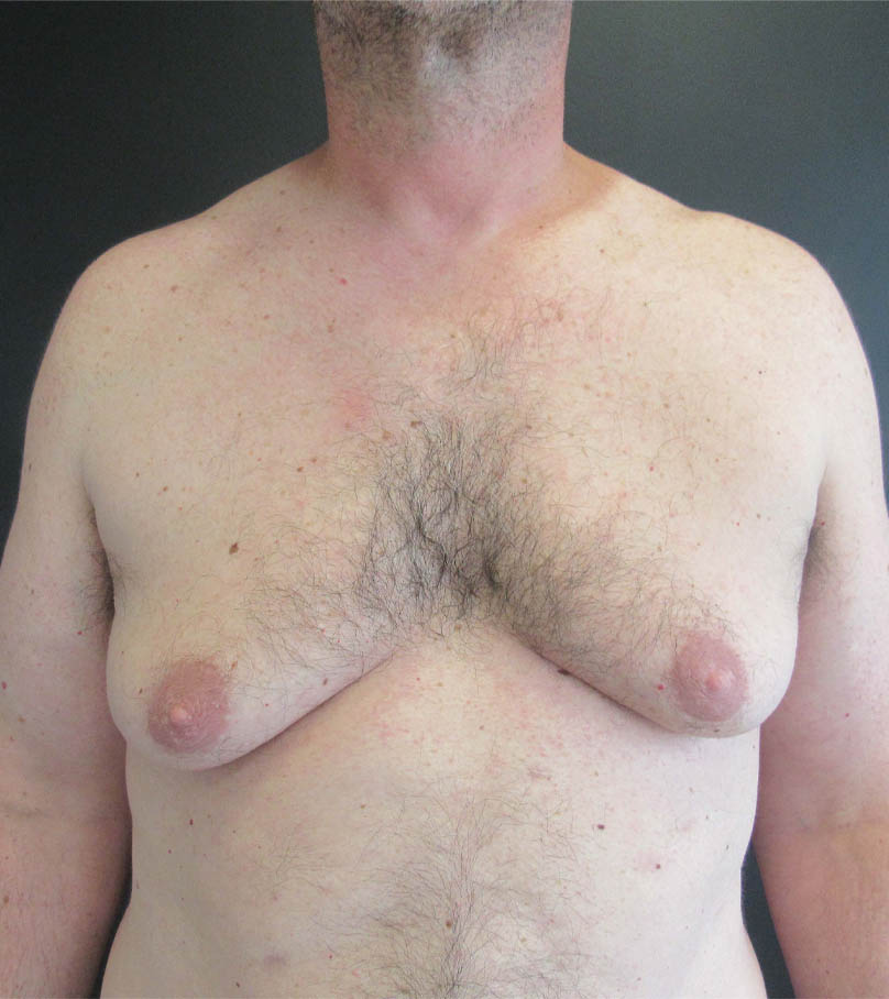 Gynecomastia case #9914