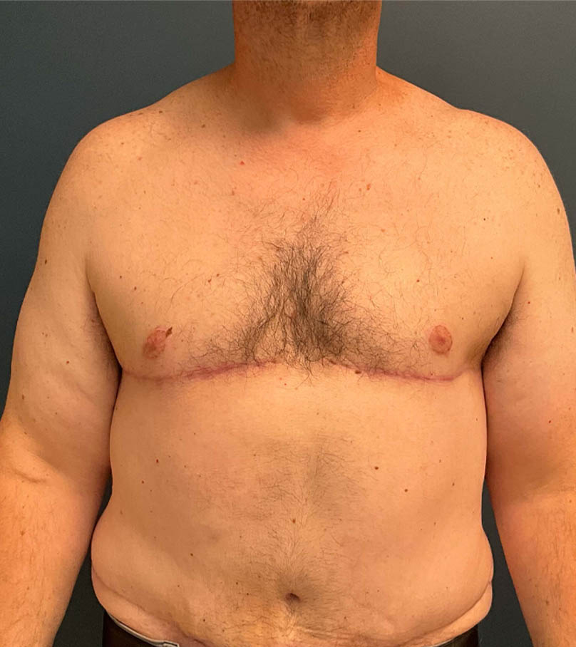 Gynecomastia case #9914