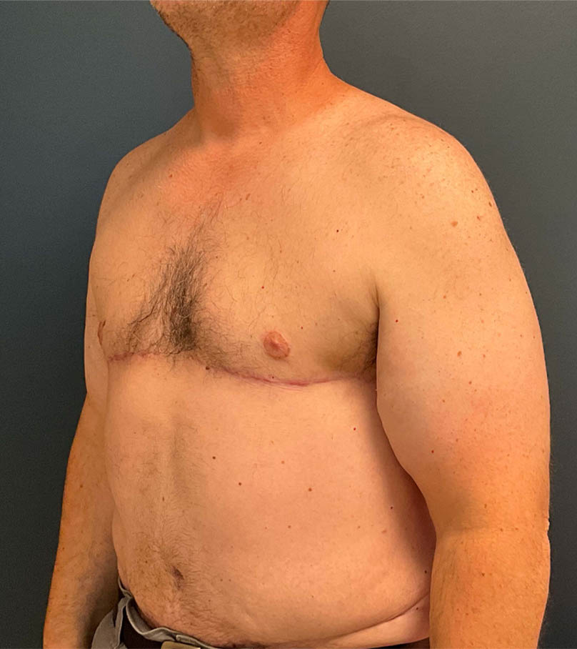 Gynecomastia case #9914