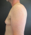 Gynecomastia case #9914