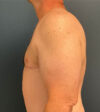 Gynecomastia case #9914