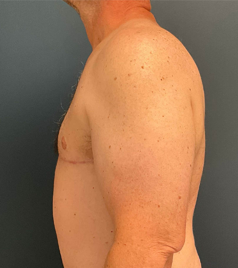 Gynecomastia case #9914