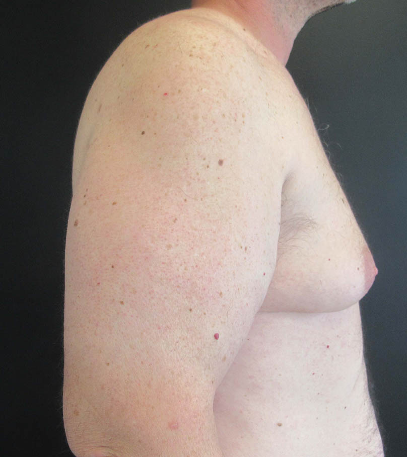 Gynecomastia case #9914