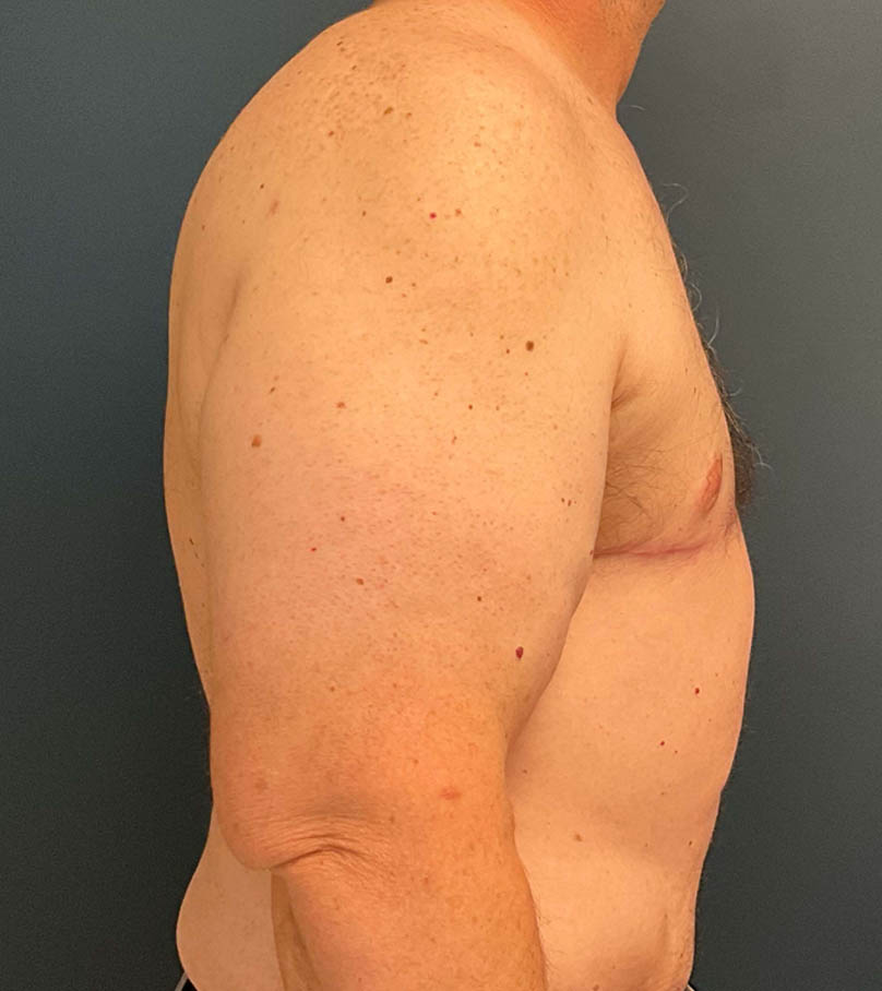 Gynecomastia case #9914