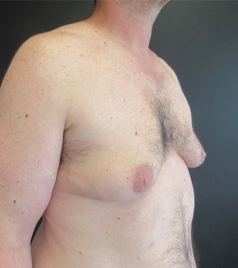 Gynecomastia case #9914