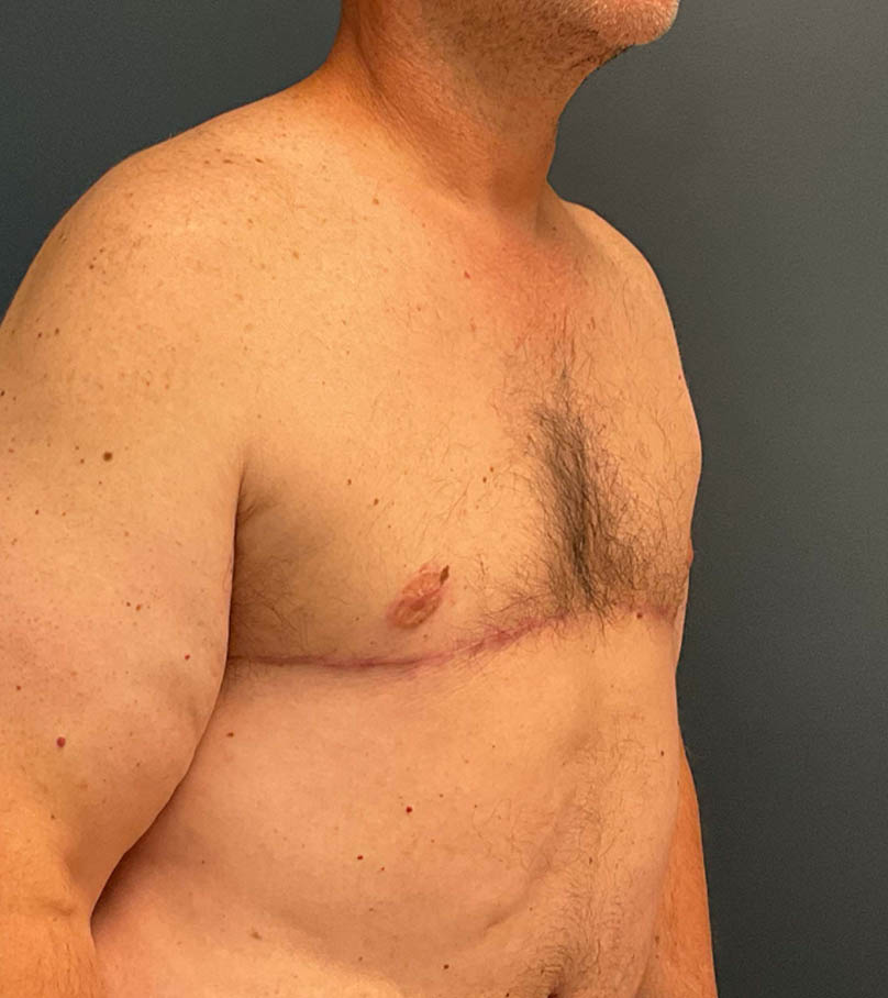 Gynecomastia case #9914