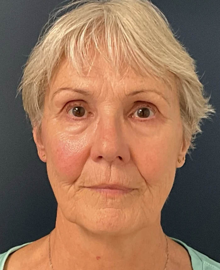 Facelift case #10072