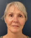 Facelift case #10072