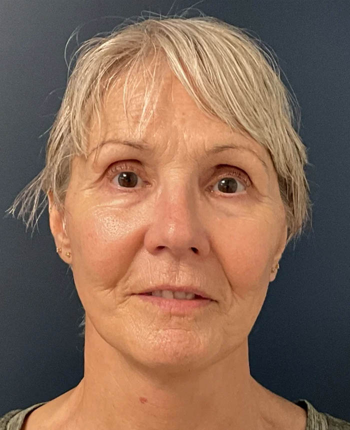 Facelift case #10072