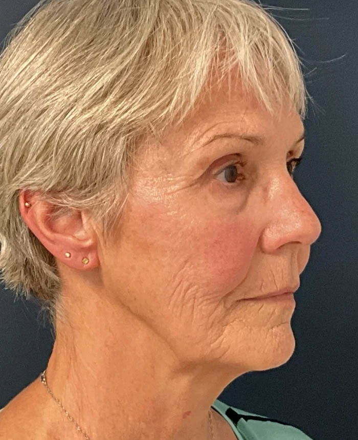 Facelift case #10072