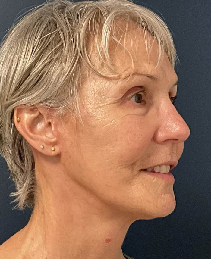 Facelift case #10072