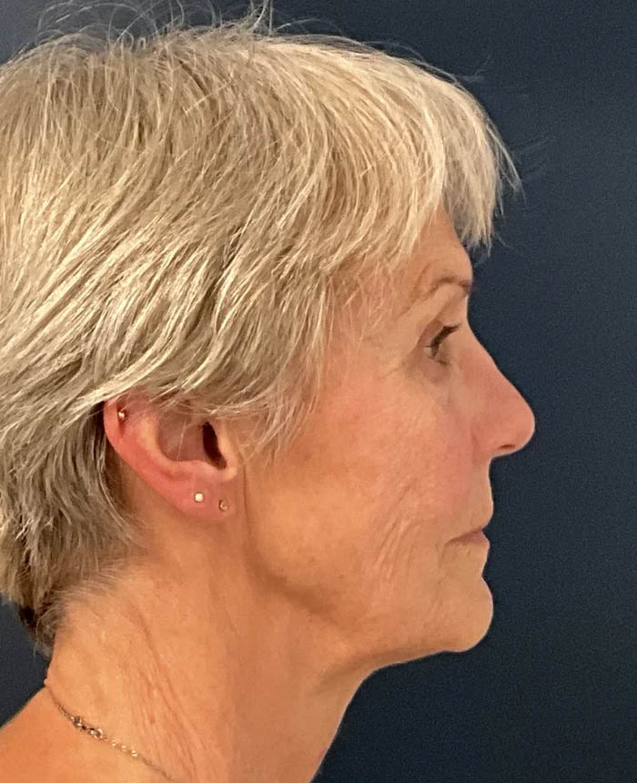 Facelift case #10072