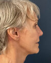 Facelift case #10072