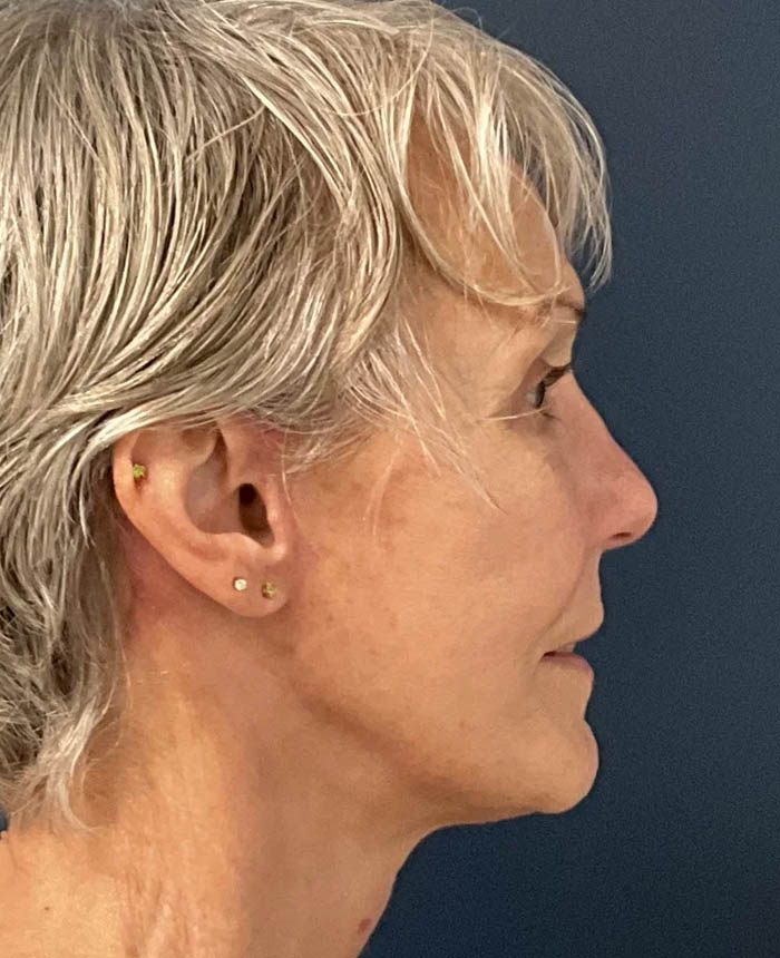 Facelift case #10072