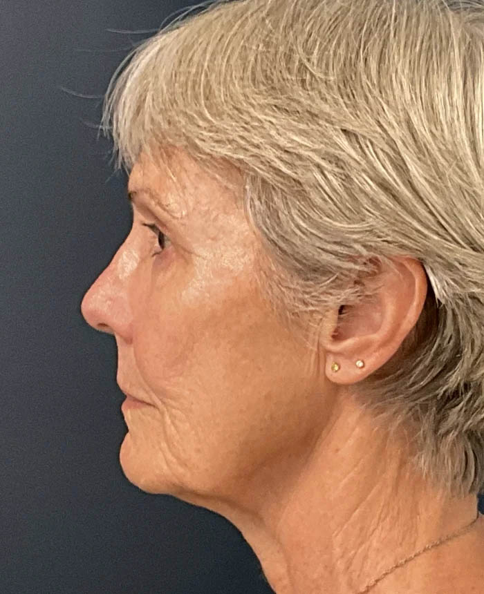 Facelift case #10072