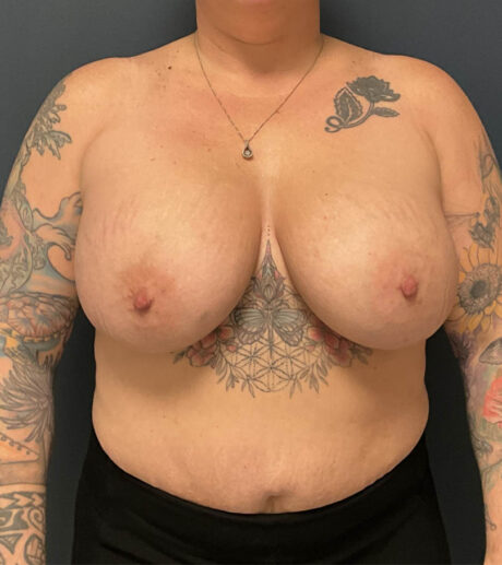 Breast Augmentation case #10326