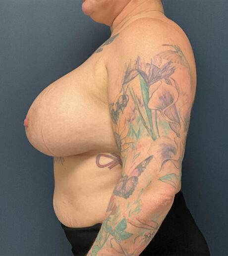 Breast Augmentation case #10326