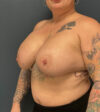 Breast Augmentation case #10326