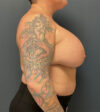 Breast Augmentation case #10326