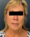Facelift case #11190