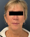Facelift case #11190